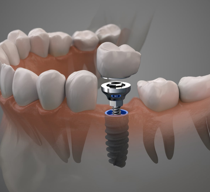 sedazione cosciente alice cutrera dentisti cutrera