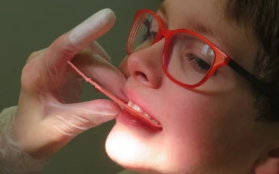 Ortodonzia bambini morso incrociato: le tipologie e i sistemi di correzione nei bambini