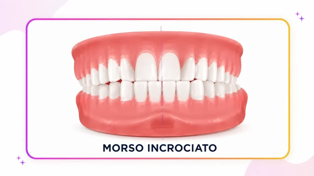 Illustrazione delle arcate dentali che mostra il morso incrociato nei bambini