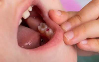 Cosa devono sapere i genitori sui molari dei Due Anni