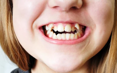 Malocclusione dentale nei bambini: perché intervenire subito