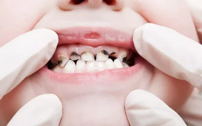 4 problemi comuni di salute orale nei bambini con Bisogni Speciali