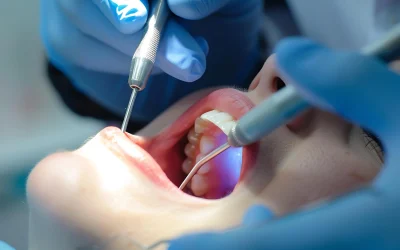 Endodonzia a Gela e Vittoria: Cos’è e Come Funziona – Tutto quello che devi sapere
