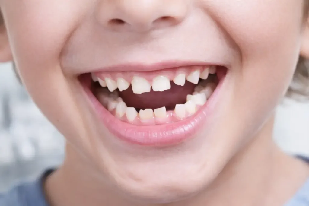 denti storti bambini denti da latte disallineati