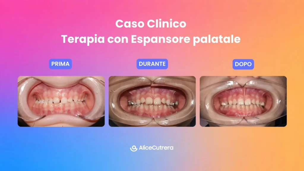 Caso clinico terapia con espansore palatale: confronto prima, durante e dopo il trattamento orthodontico